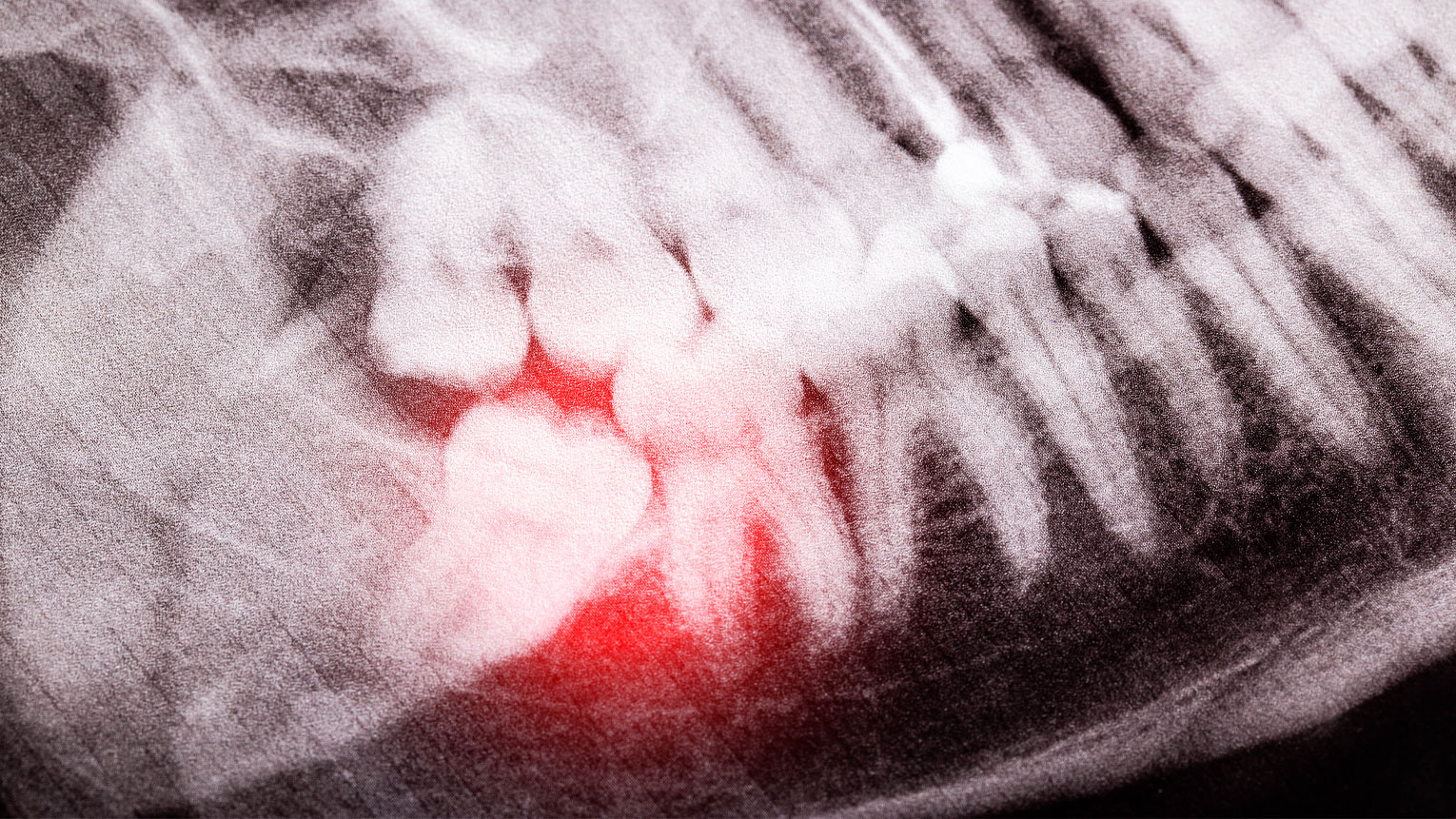 What to Do During a Dental Emergency