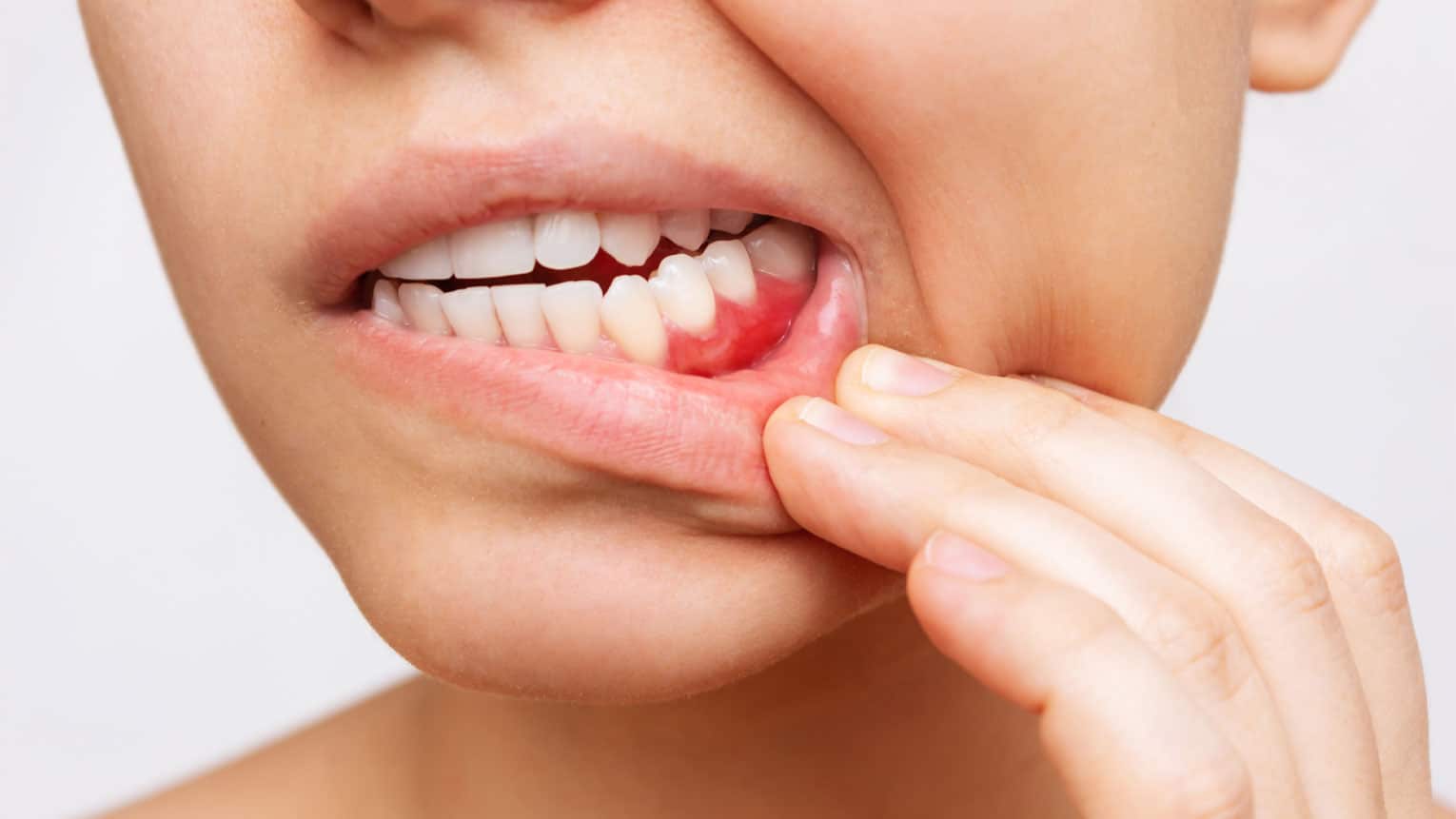 What Are the Early Signs of Gum Disease?