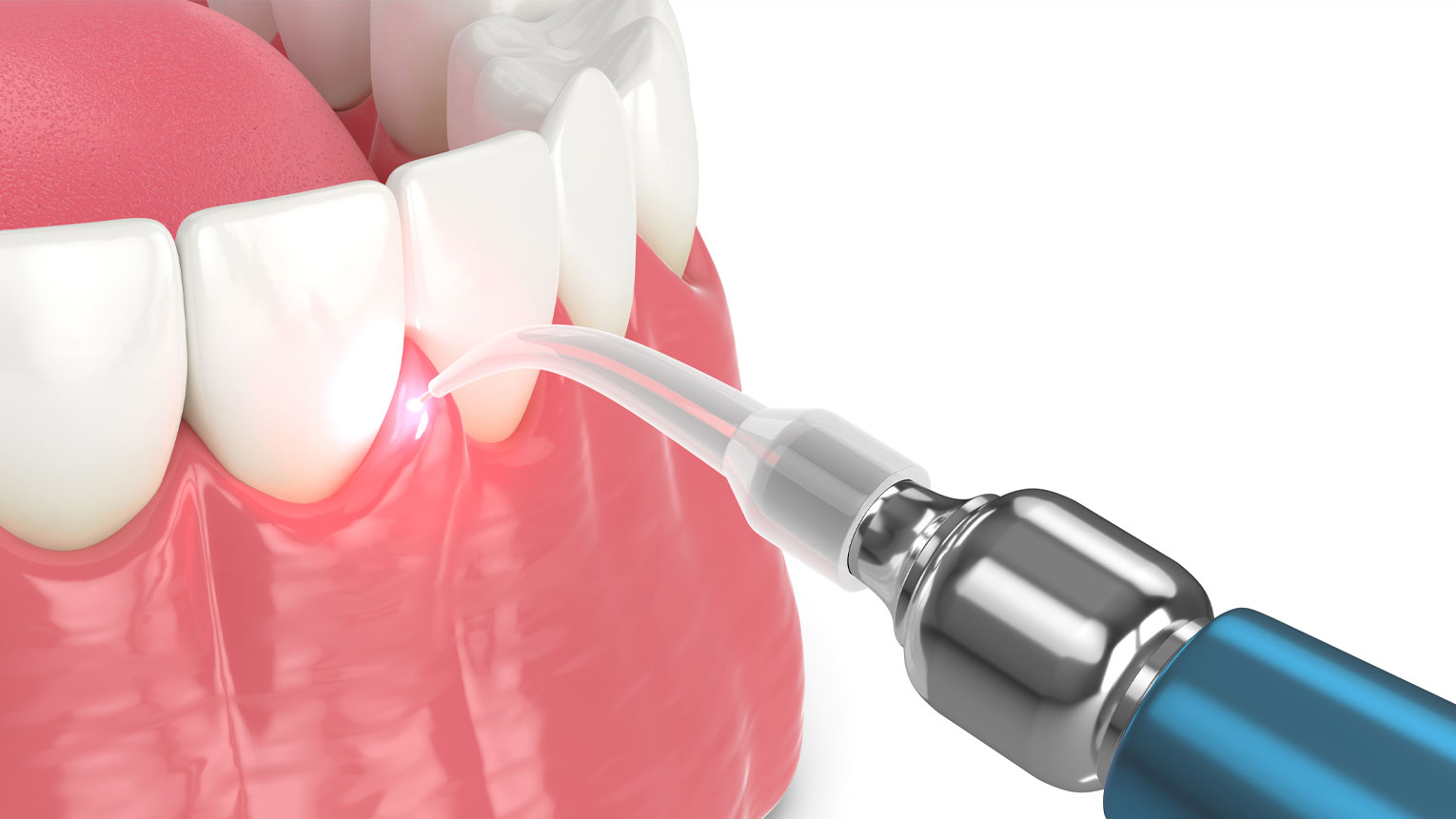 What Can Laser Dentistry Be Used For?