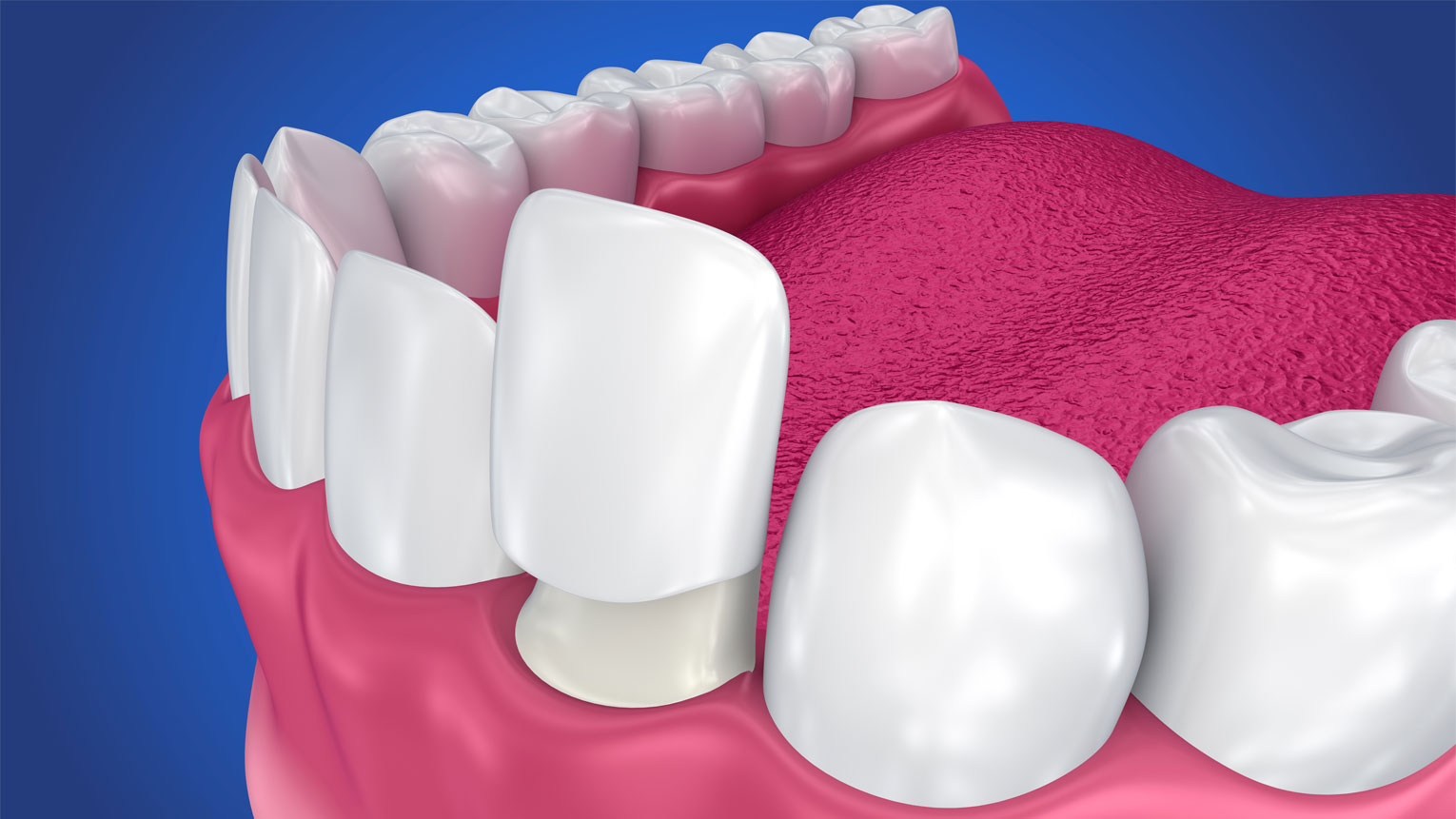 Questions to Ask Before Choosing Porcelain Veneers